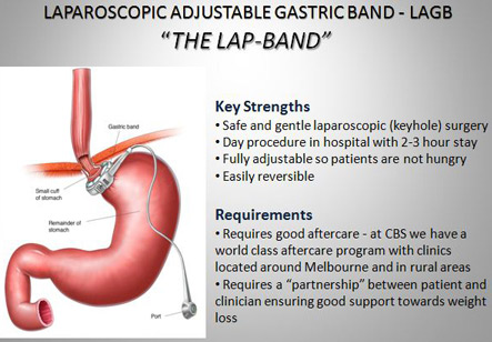 Obesity Weight Loss Surgery Cost