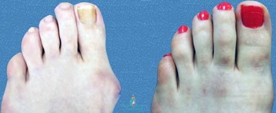 Pictures Of Before And After Of Cosmetic Foot Reconstruction Surgery 121