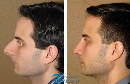 Rhinoplasty Bangkok |Nose Augmentation Surgery Reviews ...