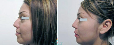 nose-surgery-bangkok-rhinoplasty-augmentation-thailand-before-after