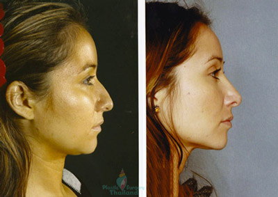 tina-nose-surgery-bangkok-rhinoplasty-augmentation-before-after-picture