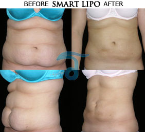 smartlipo-before-after-photos-bangkok