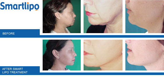 smartlipo-thailand-beforeandafter-face-chin