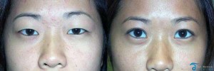 asia-eyelid-surgery-thailand