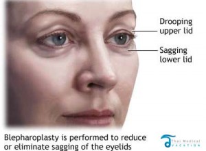 blepharoplasty-thailand