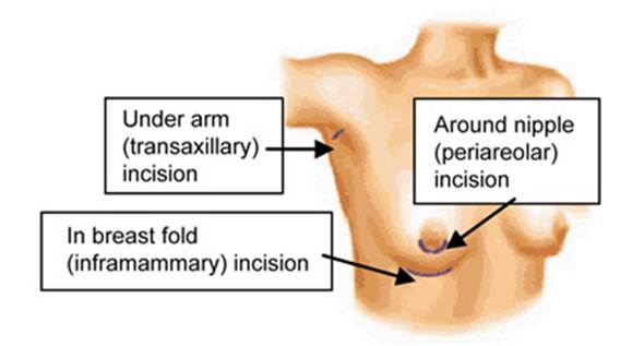 High Quality Affordable Breast Implants in Thailand Aesthetic