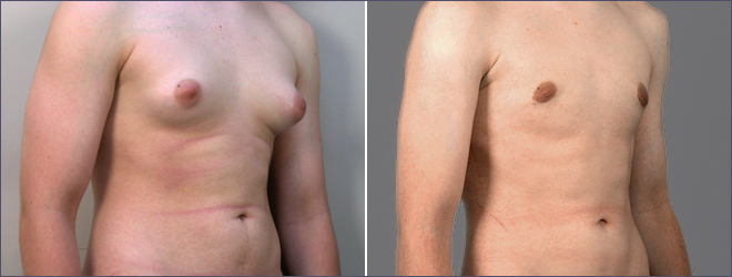 Male Gynecomastia Male Breast Reduction in Bangkok Reviews