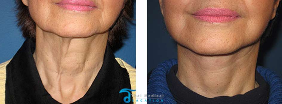 Neck Lifts in Bangkok and Phuket Thailand