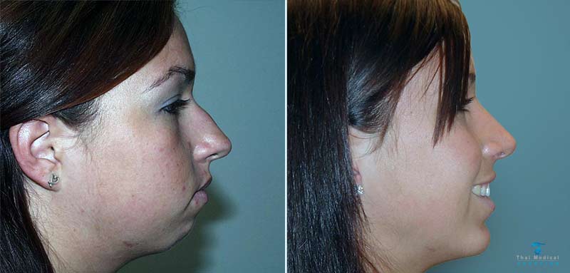 Chin Implants in Bangkok and Phuket