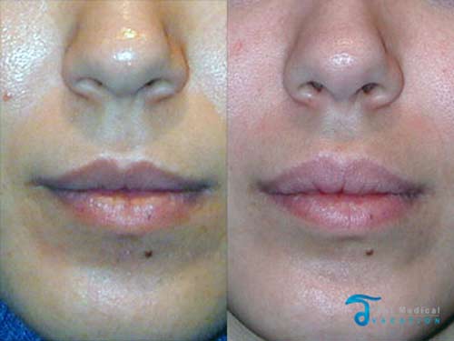 lip lifts and lip augmentation