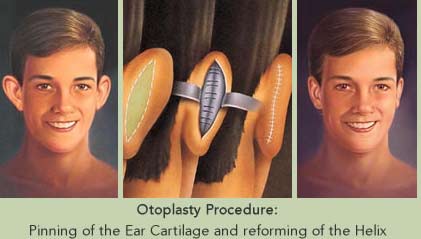 otoplasty-thailand-ear-surgery-thailand