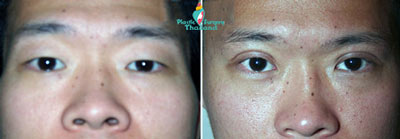 Eyelid-bleph-before-after-plastic-surgery-men