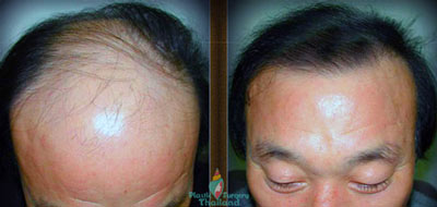 Hair-Transplants-thailand-cosmetic-surgery-men