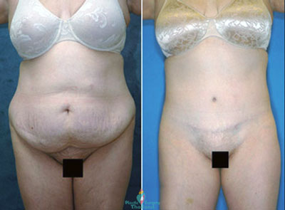 Kylie-full-tummy-tuck-bangkok-before-after-picture