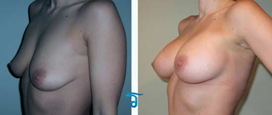 Thai-breast-implants-enlargement-before-after-pictures-doctors-bangkok-thailand