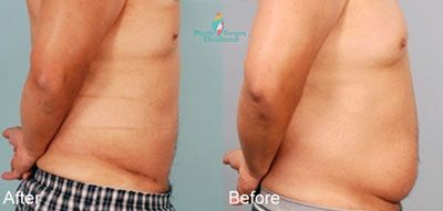 bangkok-Vaser-liposuction-james-before-after-thailand