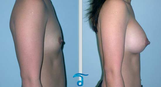 breast-augmentation-before-after-pictures-bangkok-thailand