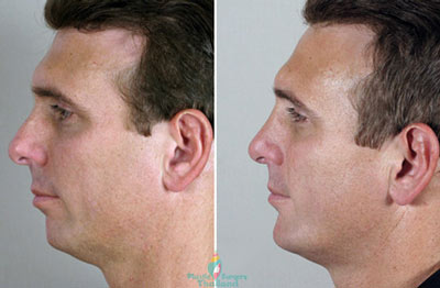 chin-neck-lipo-pictures-before-after-bangkok-phuket-plastic-surgery-men