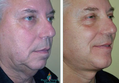 facelift-surgery-tedd-before-after-pictures-review-prices-aesthetic-surgery-center