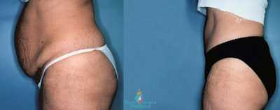 jean-luc-tummy-tuck-bangkok-abdominoplasty-doctor-reviews