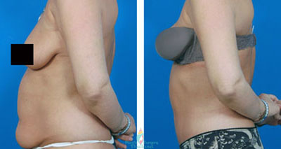 judith-mini-tummy-tuck-thailand