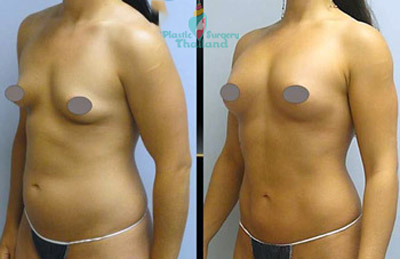 liposuction-center-phuket-thailand-bangkok-before-after-pictures