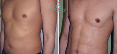 vaser-lipo-dave-bangkok-thailand-phuket-prices-before-after-pic