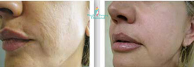 CAL-cel-facelift-before-after-ruth