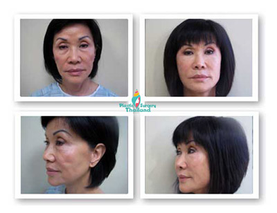 Tara-stemcell-facelift-thailand-before-after