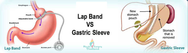 gastric-sleeve-vs-gastric-bypass-thailand-comparison