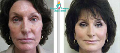 hannah-CAL-enriched-face-lift-thailand-before-after