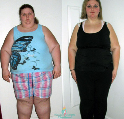 Weight Loss Surgery Bangkok Bariatric Surgery Reviews