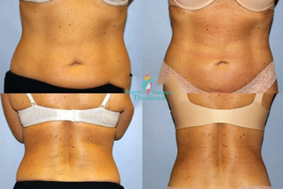non-surgical-coolsculpting-liposuction-freeze-cryoliposis-reviews-before-after