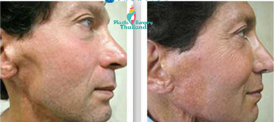 richard-stem-cell-facelift-before-after-dave-after-reconstruction