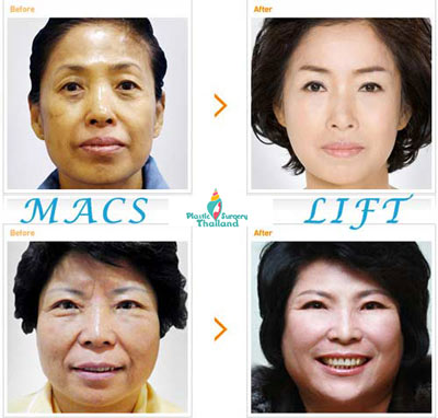 MACS-Facelift-Chen-Bangkok-Thailand