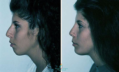 chin-implants-barb-thailand-before-and-after-kim