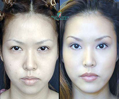 chin-implants-kimmy-thailand-before-and-after