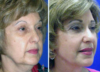 face-lift-thailand-maryanne-stem-cell-face