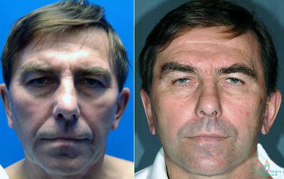 facelift-necklift-ted-thailand