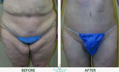 inner-thigh-lift-bangkok-thailand-before-after-pictures