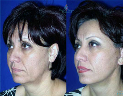 surgical-facelift-jean-martinez-thailand