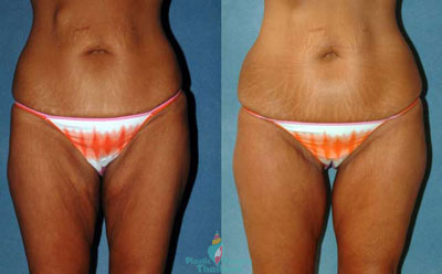 thigh-lift-thailand-before-after-pictures