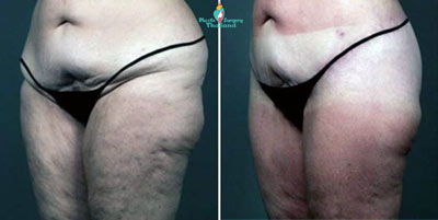 thigh-lift-thailand-butt-lift-thailand-before-after-picture