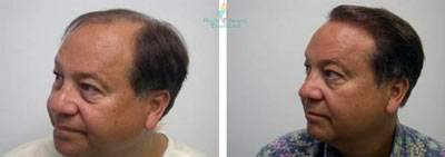 Hair-restoration-neograft-thailand