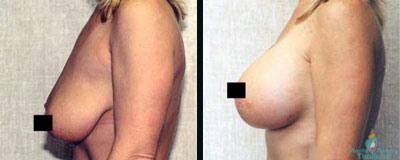 breast-augmentation-lift-thailand