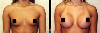 breast-implants-bangkok-thailand