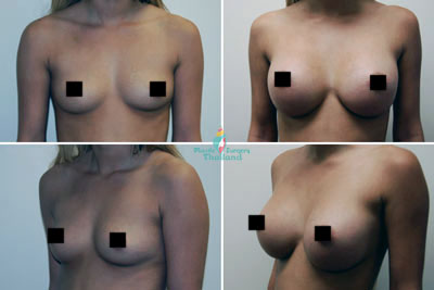 breast-implants-before-after-june