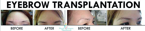 eyebrow-transplants-bangkok-thailand-before-after-phuket-fut-fue-neograft-stemcell