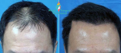 Hair Transplants in Bangkok |Hair Restoration in Thailand Cost Reviews -  Aesthetic Surgery Center of Thailand