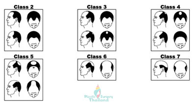 hair-transplant-zones-thailand